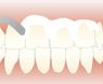 研磨剤で歯を研磨