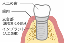 インプラントの構造