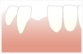 インプラントの症例 【1本の場合】