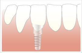 インプラントの症例 【1本の場合】