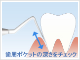 歯石除去の流れ