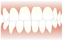 ホワイトニングの症例