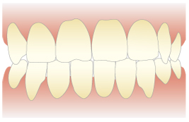 ホワイトニングの症例