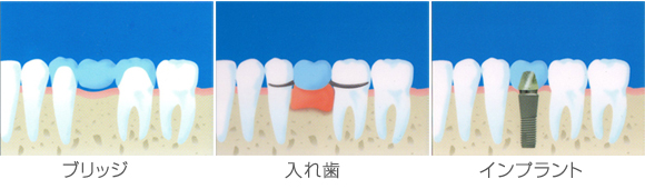 従来の治療方法とインプラント治療の比較